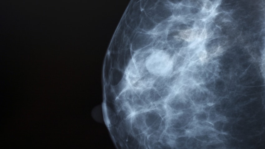 Dense Breast Tissue: What It Means and What to Know