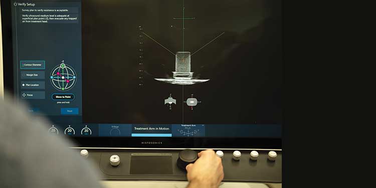 the monitor used to guide the histotripsy machine illustrates where to target sound waves